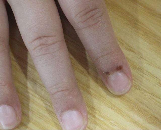 사마귀 치료 전