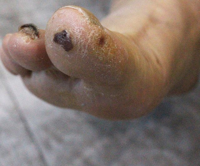 사마귀 치료 전