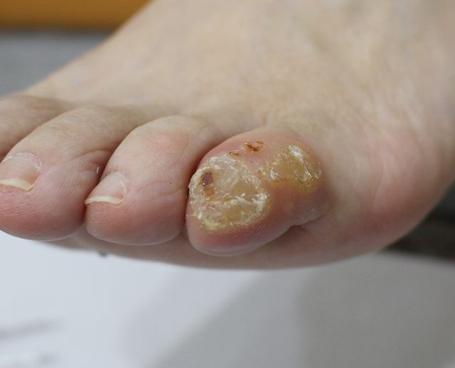 사마귀 치료 전