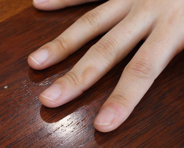 22세 여성 · 7개월 경과