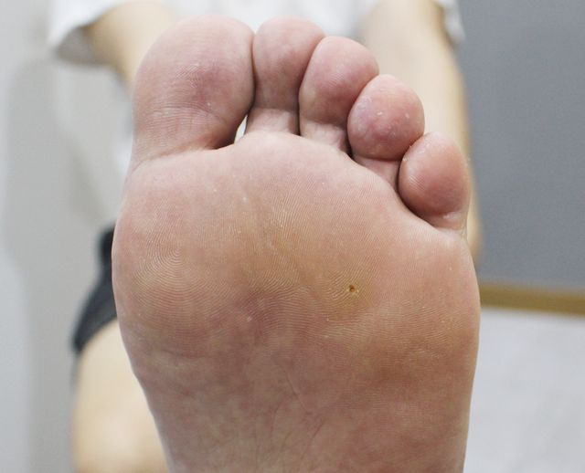 사마귀 치료 전
