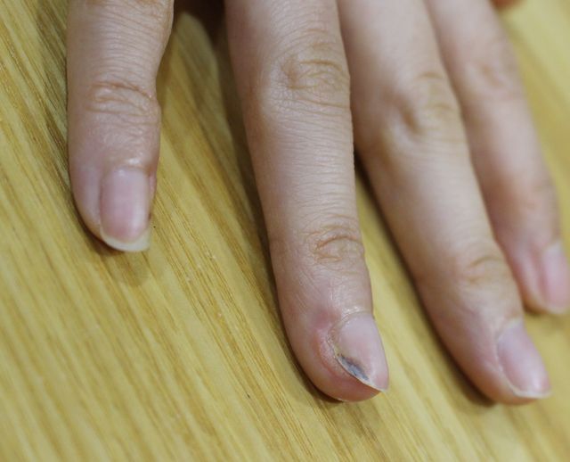 사마귀 치료 전